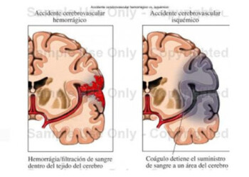 ACV se genera por la obstrucción de arterias cerebrales