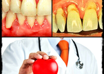 La reducción del uso de antibióticos preventivos antes de tratamientos dentales puede haber contribuido al aumento de infecciones de las válvulas cardíacas