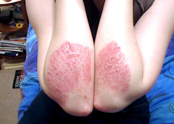 La psoriasis es una enfermedad cutánea de origen autoinmune, por lo que su tratamiento debe realizarse de forma secuencial