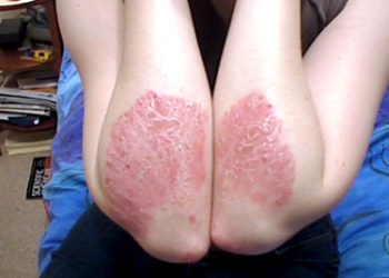 Dependiendo del tipo y la ubicación de la psoriasis, ésta puede causar complicaciones exponiendo al paciente a un mayor riesgo de desarrollar otras afecciones