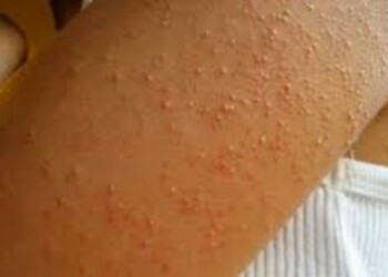 Autoridades sanitarias reportan 1.392 casos en primer trimestre de 2016.