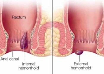 Uno de los principales factores en la prevención de las hemorroides es poder defecar regularmente, sin pujar.