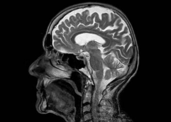 Un equipo de científicos del Instituto de Investigación del Cáncer de Londres, Reino Unido, ha realizado el estudio sobre el cáncer cerebral más exhaustivo de la historia y ha identificado 13 alteraciones genéticas previamente no descubiertas
