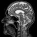 Un equipo de científicos del Instituto de Investigación del Cáncer de Londres, Reino Unido, ha realizado el estudio sobre el cáncer cerebral más exhaustivo de la historia y ha identificado 13 alteraciones genéticas previamente no descubiertas