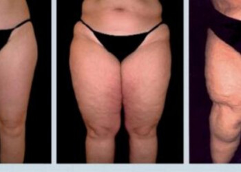 El lipedema (también conocido como “síndrome de la inflamación”) es una enfermedad crónica que afecta en mayor parte a las mujeres.