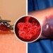 Una muerte por dengue hemorragico enciende alarmas en El Paso